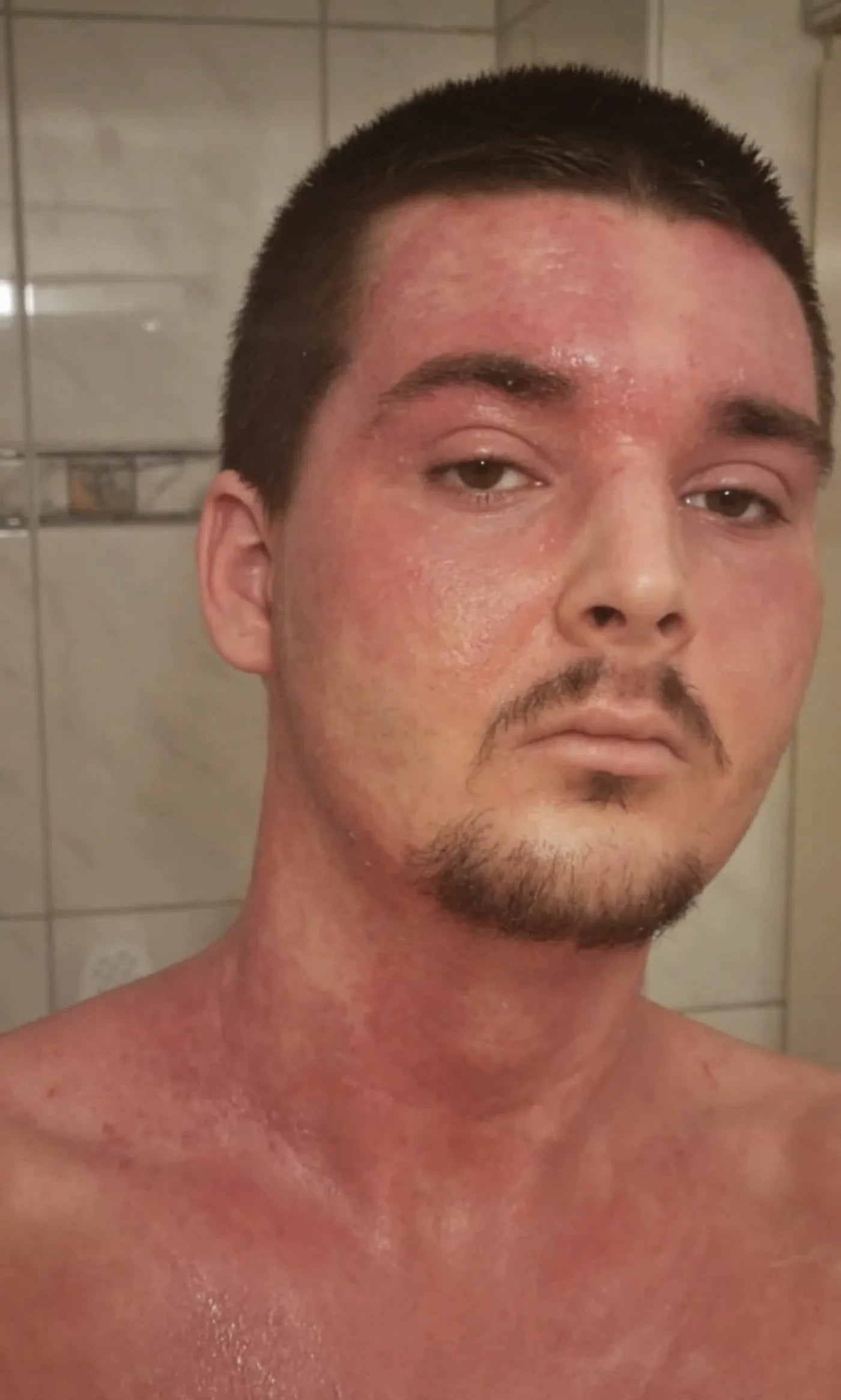Hals und Brust betroffen